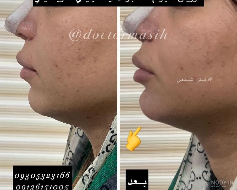 عکس قبل و بعد از تزریق فیلر گونه و چانه - کلینیک زیبایی سام عکس قبل و بعد از تزریق فیلر گونه و چانه - کلینیک زیبایی سام