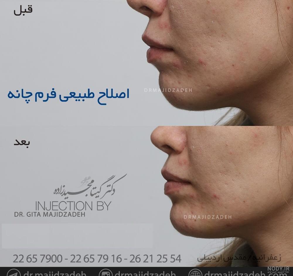 عکس های قبل و بعد از تزریق ژل گونه | کلینیک زیبایی یاس عکس های قبل و بعد از تزریق ژل گونه | کلینیک زیبایی یاس