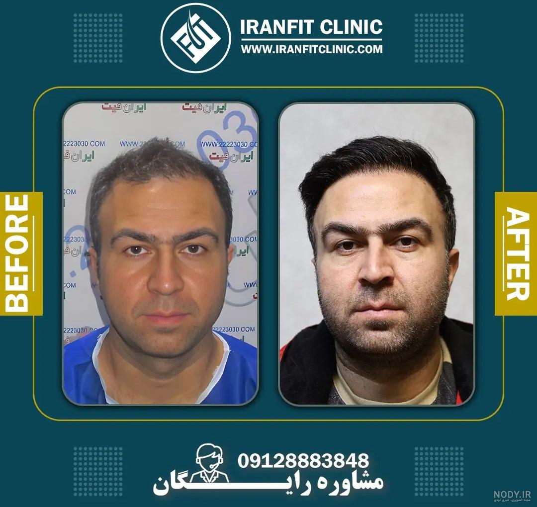 عکس قبل و بعد از کاشت مو