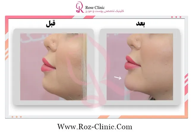 عکس قبل و بعد تزریق ژل به چانه عکس قبل و بعد تزریق ژل به چانه