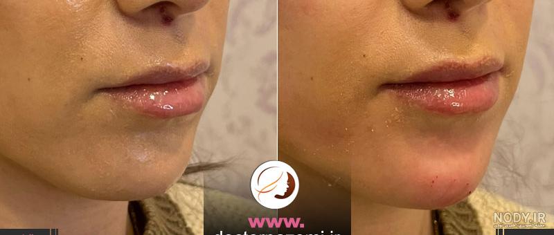 عکس قبل و بعد تزریق ژل چانه