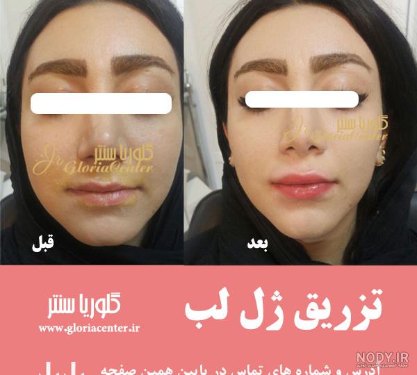 عکس قبل و بعد تزریق ژل و چربی💖 در کلینیک زیبایی اکسیرجوانی🧔
