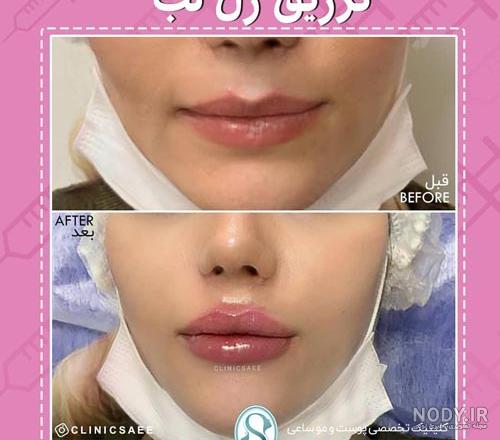عکس قبل و بعد تزریق ژل گونه - عکس نودی