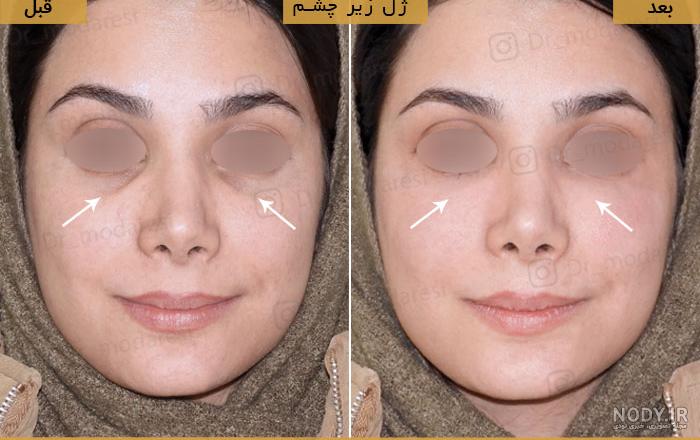 عکس قبل و بعد فیلر زیر چشم - تهران کلینیک
