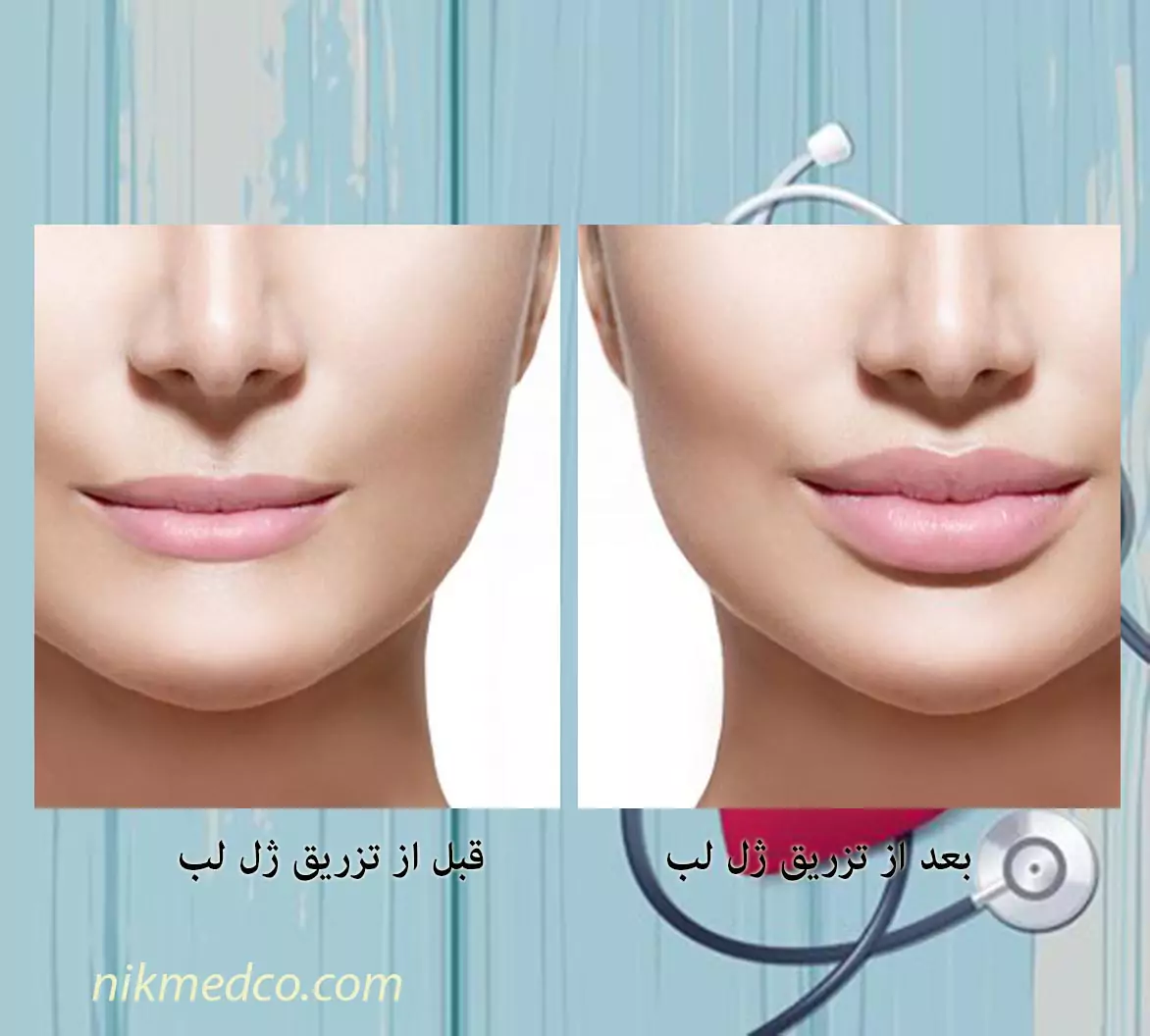 عکس قبل و بعد فیلر صورت – کلینیک دندانپزشکی