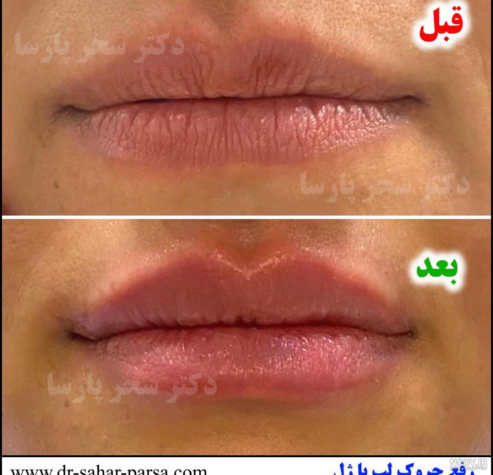 عکس قبل و بعد فیلر گونه و خط خنده - کلینیک زیبایی سام