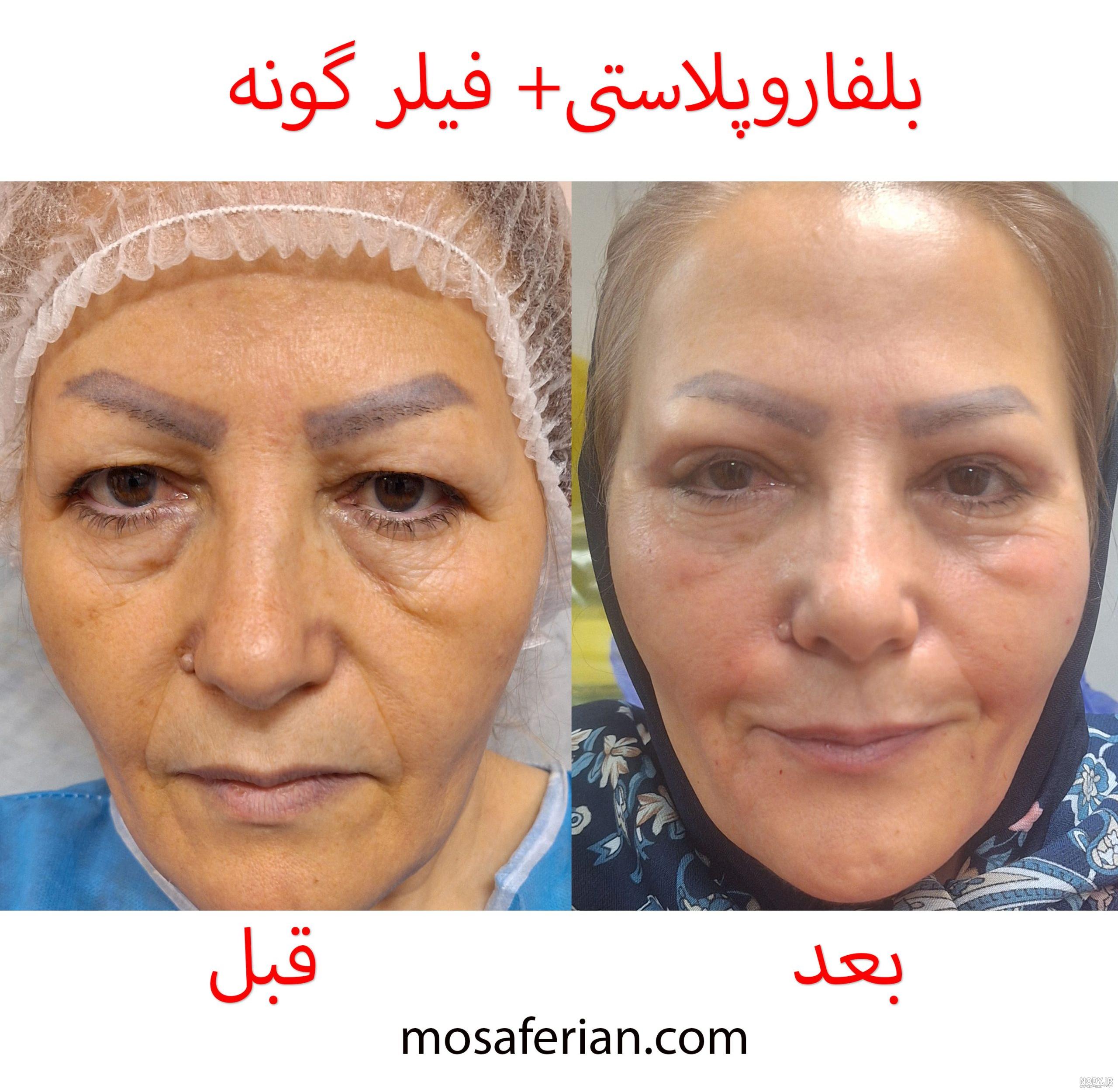 عکس قبل و بعد ژل لب - دکتر سحر پارسا