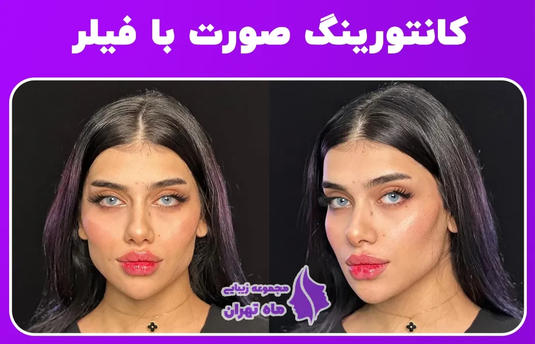 فیلر چانه - درمانگاه تخصصی پوست،مو و زیبایی گونه فیلر چانه - درمانگاه تخصصی پوست،مو و زیبایی گونه