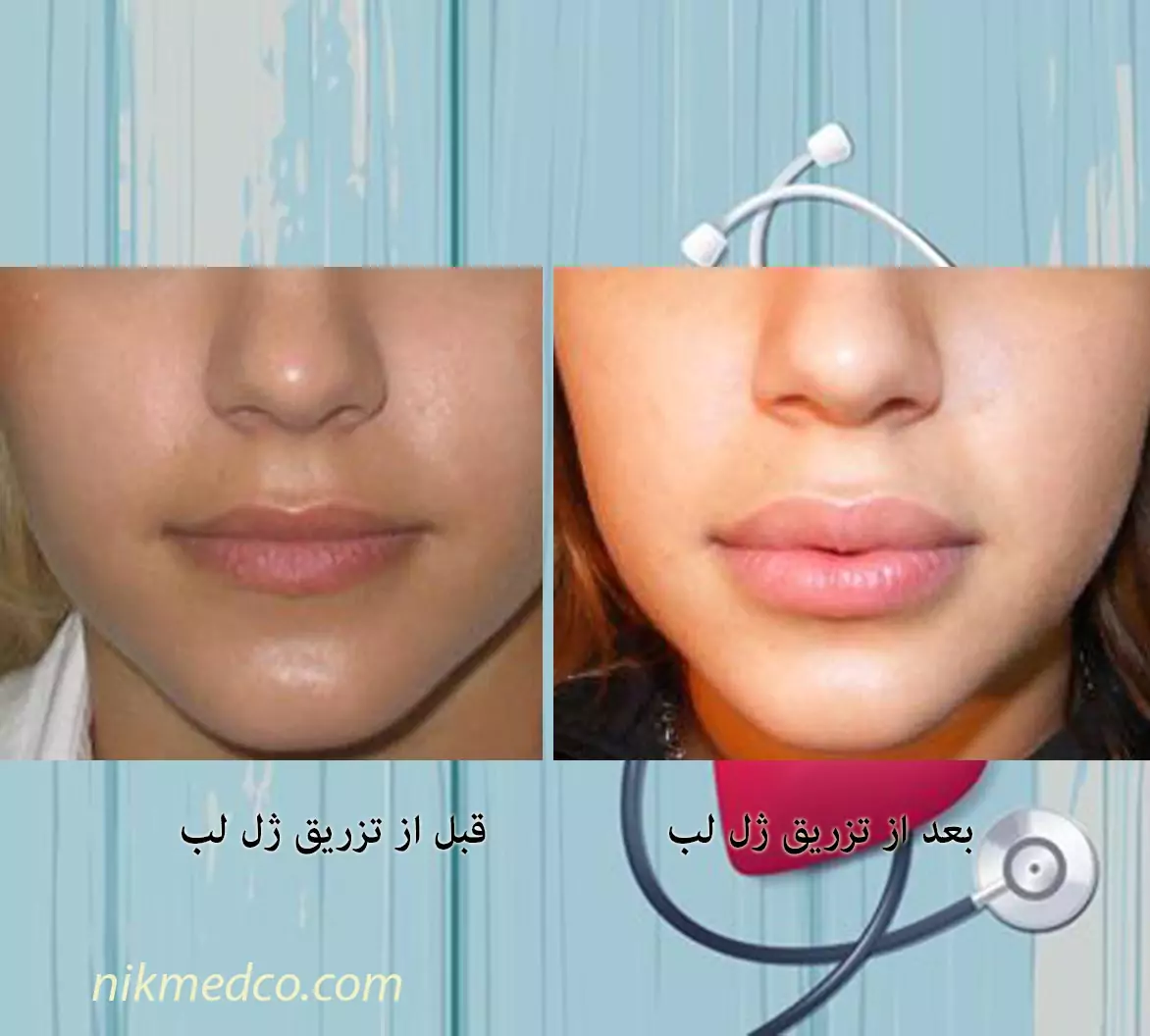 نمونه عکس قبل و بعد تزریق فیلر - کلینیک زیبایی سام