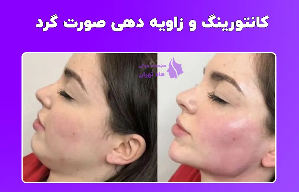 نمونه عکس قبل و بعد تزریق فیلر - کلینیک زیبایی سام نمونه عکس قبل و بعد تزریق فیلر - کلینیک زیبایی سام