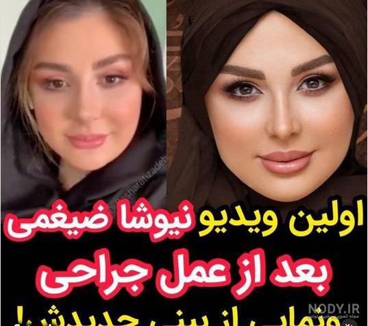 نیوشا ضیغمی قبل و بعد از عمل+تصاویر نیوشا ضیغمی قبل و بعد از عمل+تصاویر