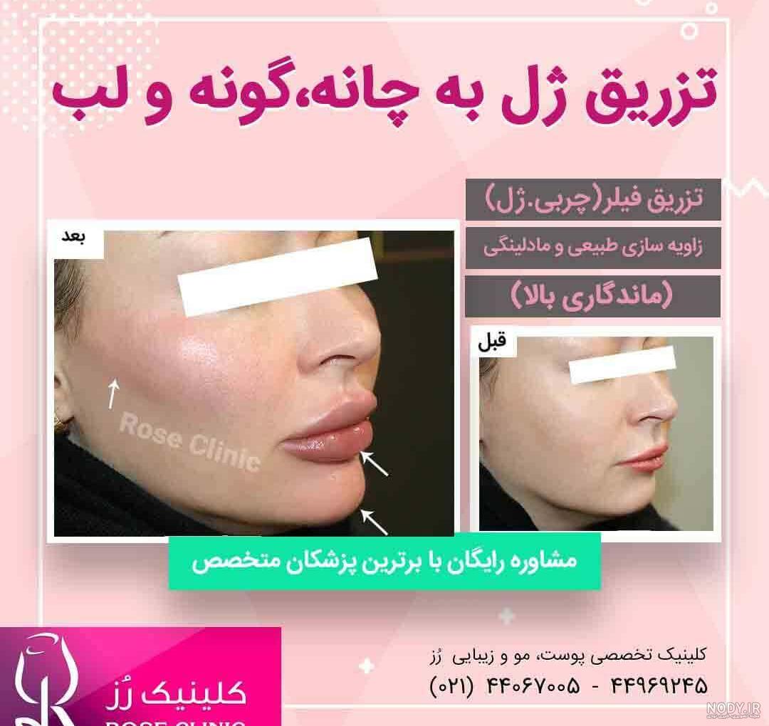 ژل جالپرو در جوانسازی پوست , "عکس قبل و بعد جالپرو" ژل جالپرو در جوانسازی پوست , "عکس قبل و بعد جالپرو"
