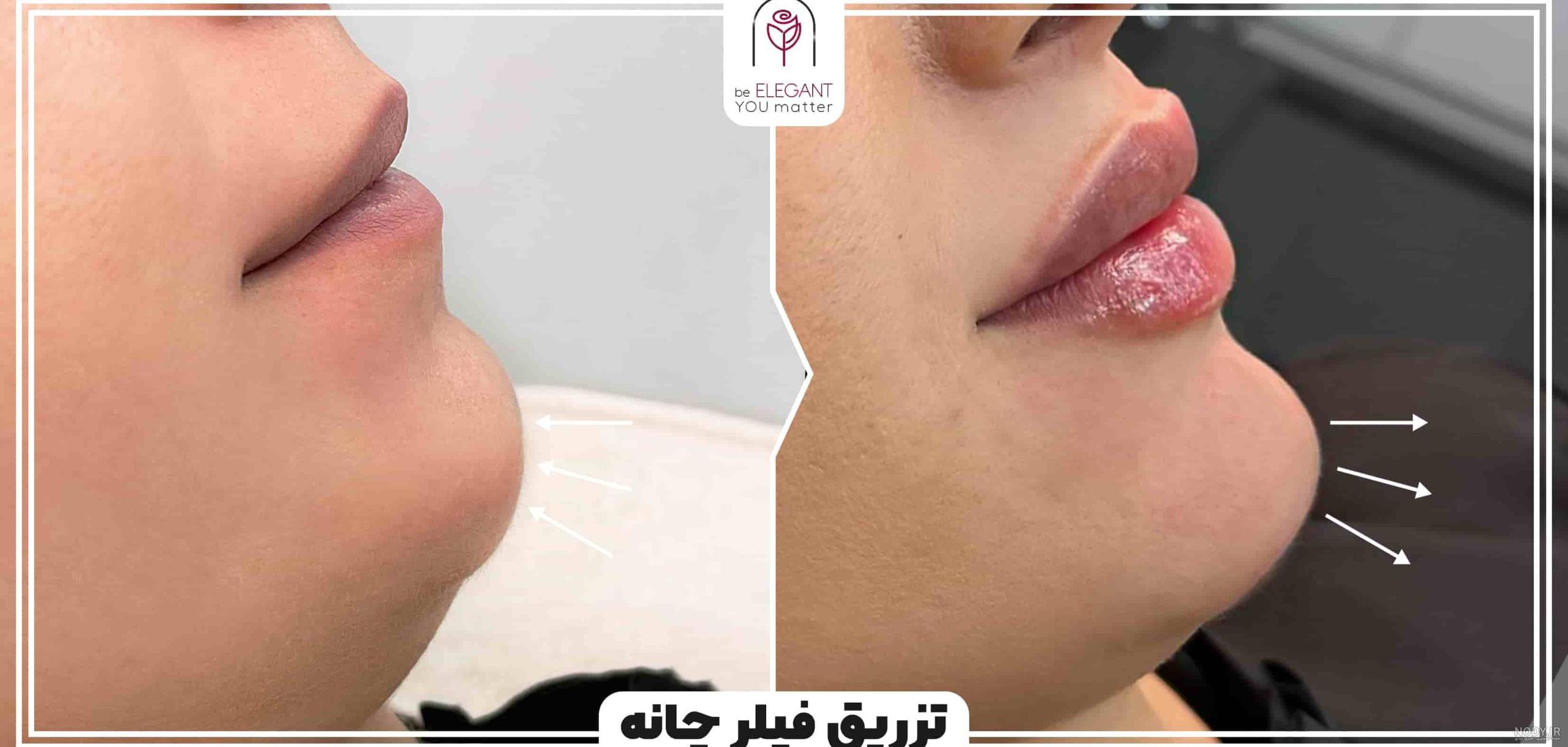 کانتورینگ موقتی صورت با فیلر - عکس قبل و بعد + قیمت و فیلم کانتورینگ موقتی صورت با فیلر - عکس قبل و بعد + قیمت و فیلم