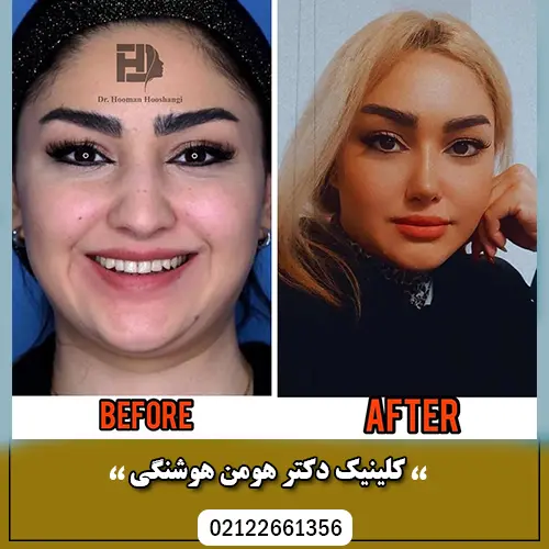 عکس قبل و بعد فیلر گونه و خط خنده - کلینیک زیبایی سام عکس قبل و بعد فیلر گونه و خط خنده - کلینیک زیبایی سام