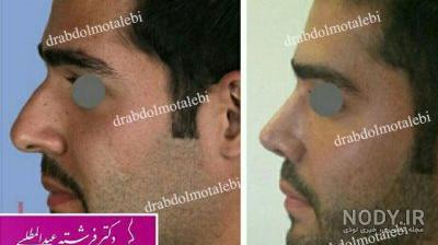 عکس قبل و بعد عمل بینی احسان علیخانی - دکتر محمد صوفی زاده عکس قبل و بعد عمل بینی احسان علیخانی - دکتر محمد صوفی زاده