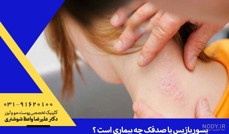 8 علائم پسوریازیس در کودکان 8 علائم پسوریازیس در کودکان