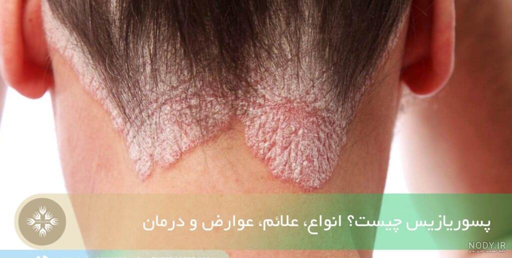 بیماری پسوریازیس؛ 14 روش درمان خانگی پسوریازیس بیماری پسوریازیس؛ 14 روش درمان خانگی پسوریازیس