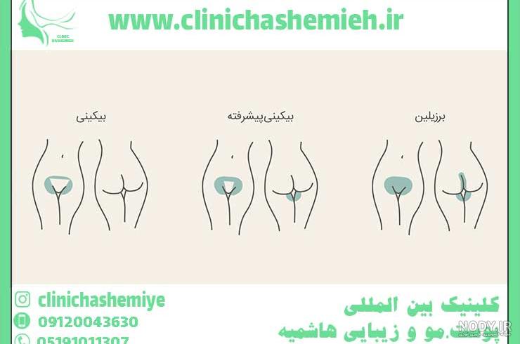 آموزش اپیلاسیون بیکینی در منزل | پوستی لطیف داشته باشید 😉