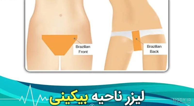 اپیلاسیون موهای زائد و عوارض وکس بیکینی - کلینیک زیبایی رازی کاشت مو کاشت  ابرو تزریق ژل و بوتاکس