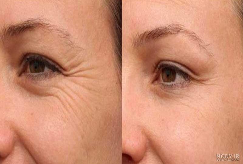 💝 هزینه فیلر زیر چشم | قیمت فیلر زیر چشم سال 1403 | ارزان‌ترین فیلر زیر چشم
