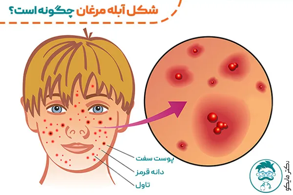 آبله مرغان چیست؟مدت واگیر، علائم+درمان ابله مرغون -دکترمایکو آبله مرغان چیست؟مدت واگیر، علائم+درمان ابله مرغون -دکترمایکو