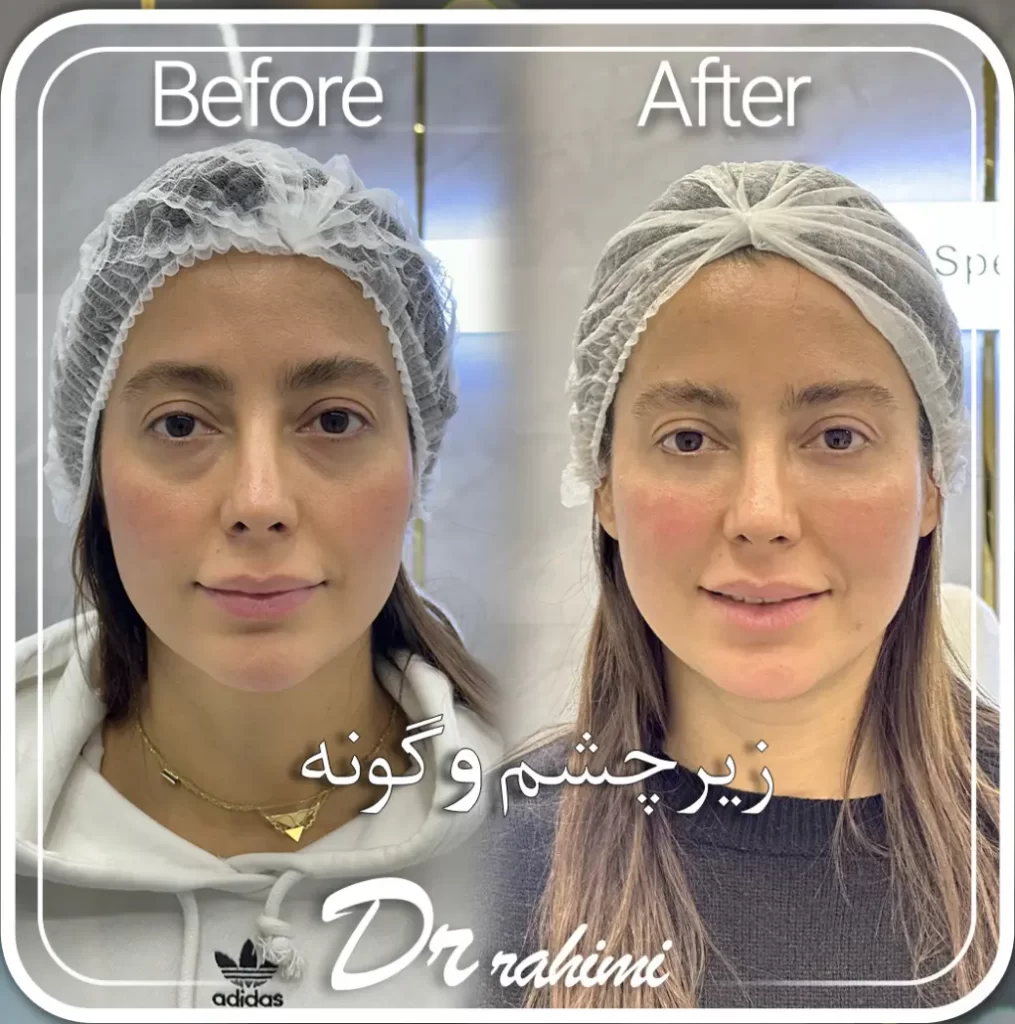 تزریق فیلر زیر چشم برای رفع تیرگی - کلینیک زیبایی سام تزریق فیلر زیر چشم برای رفع تیرگی - کلینیک زیبایی سام