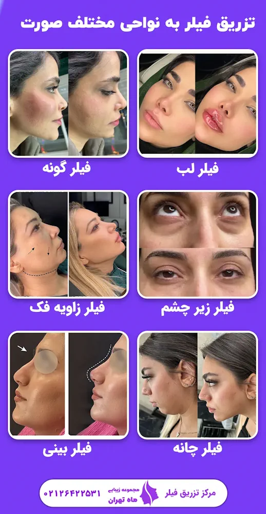 تزریق فیلر زیر چشم | قیمت، مزایا، عوارض، عکس قبل و بعد از تزریق فیلر زیر چشم | قیمت، مزایا، عوارض، عکس قبل و بعد از