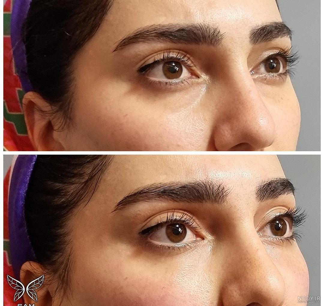 تزریق فیلر زیر چشم + هزینه و مزایای ژل چشم تزریق فیلر زیر چشم + هزینه و مزایای ژل چشم