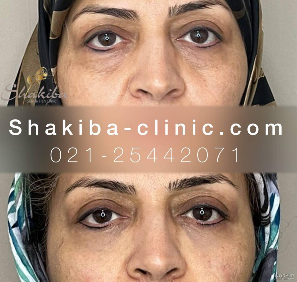 تصاویر خدمات لیزر و زیبایی بیماران کلینیک بصورت واقعی - کلینیک کاملیا تصاویر خدمات لیزر و زیبایی بیماران کلینیک بصورت واقعی - کلینیک کاملیا