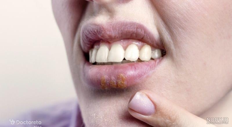 تفاوت آفت دهان با زگیل دهانی؛ از کجا بفهمیم گرفتار کدام عارضه شده‌ایم؟| تاج