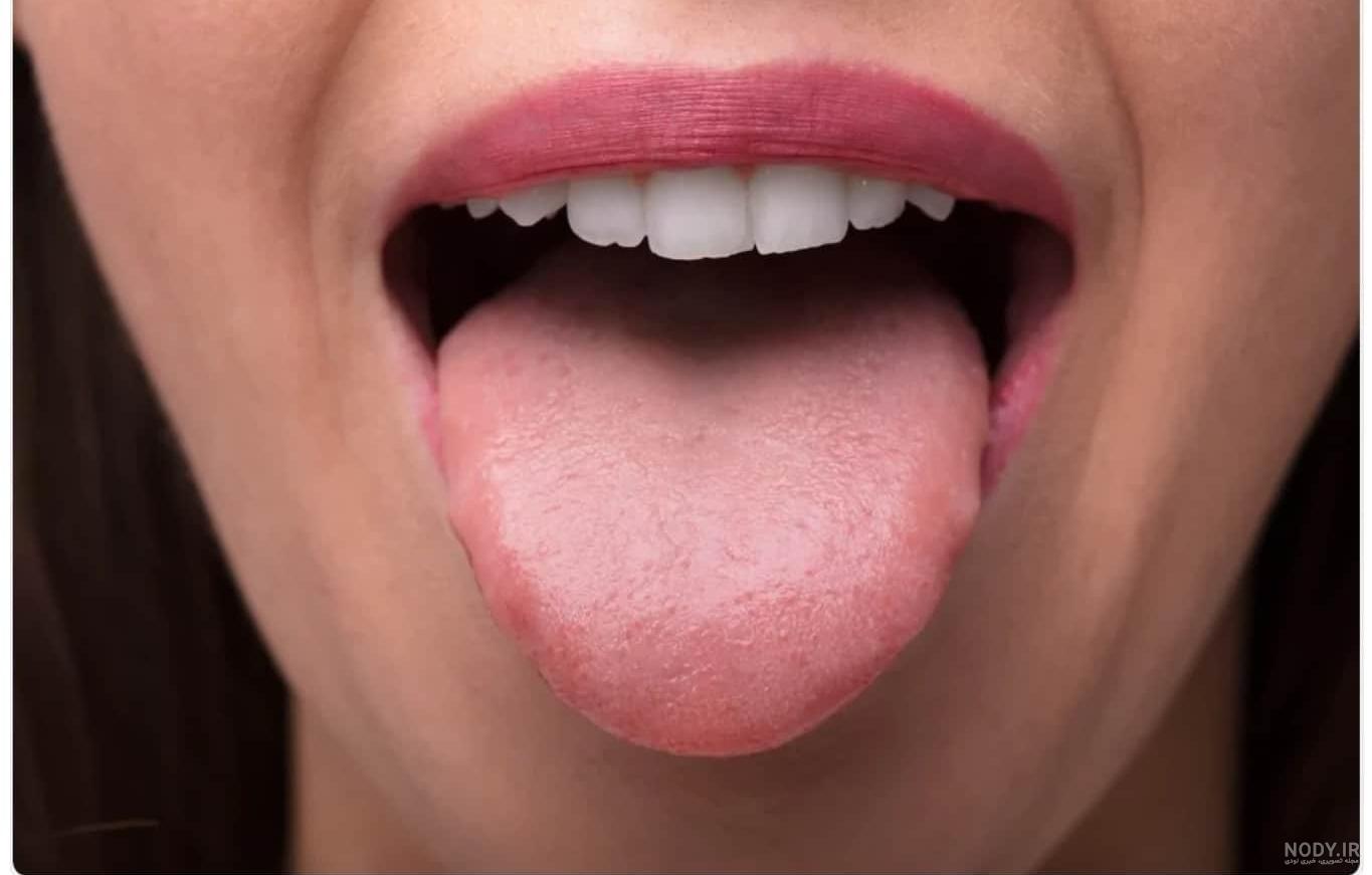 تفاوت آفت و زگیل دهانی را به طور کامل بدانید! - دکتر عاطفه توانگر تفاوت آفت و زگیل دهانی را به طور کامل بدانید! - دکتر عاطفه توانگر