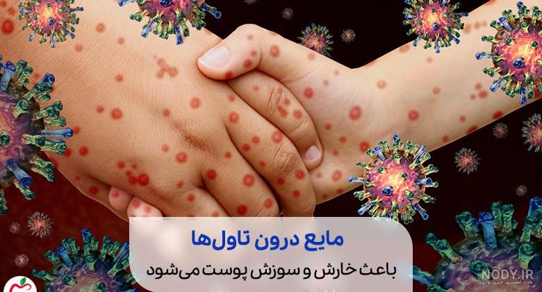 تفاوت بین آلرژی ، آبله مرغان و سرخک - آزمایشگاه پاتوبیولوژی توانا تفاوت بین آلرژی ، آبله مرغان و سرخک - آزمایشگاه پاتوبیولوژی توانا