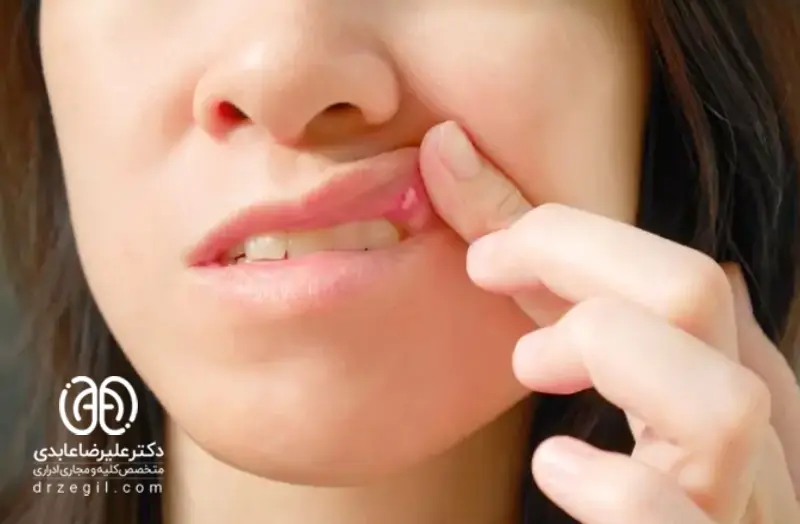 زگیل دهانی (HPV) یافته های جدید در مورد ویروس پاپیلومای انسانی دهان زگیل دهانی زگیل دهانی (HPV) یافته های جدید در مورد ویروس پاپیلومای انسانی دهان زگیل دهانی