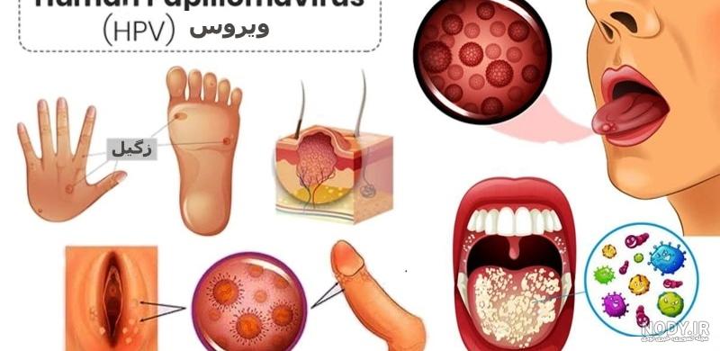 زگیل دهانی را چگونه درمان کنم؟علائم و تفاوت آفت و زگیل دهانی زگیل دهانی را چگونه درمان کنم؟علائم و تفاوت آفت و زگیل دهانی