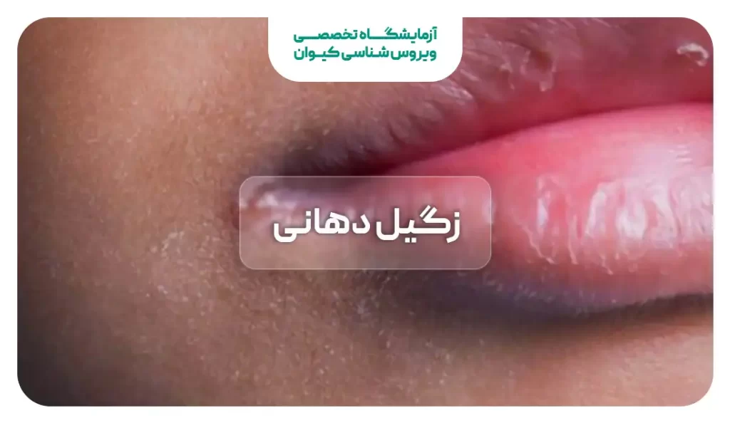 زگیل دهانی (زگیل تناسلی در دهان) | درمان خانگی و دارویی | کلینیک زارعی زگیل دهانی (زگیل تناسلی در دهان) | درمان خانگی و دارویی | کلینیک زارعی