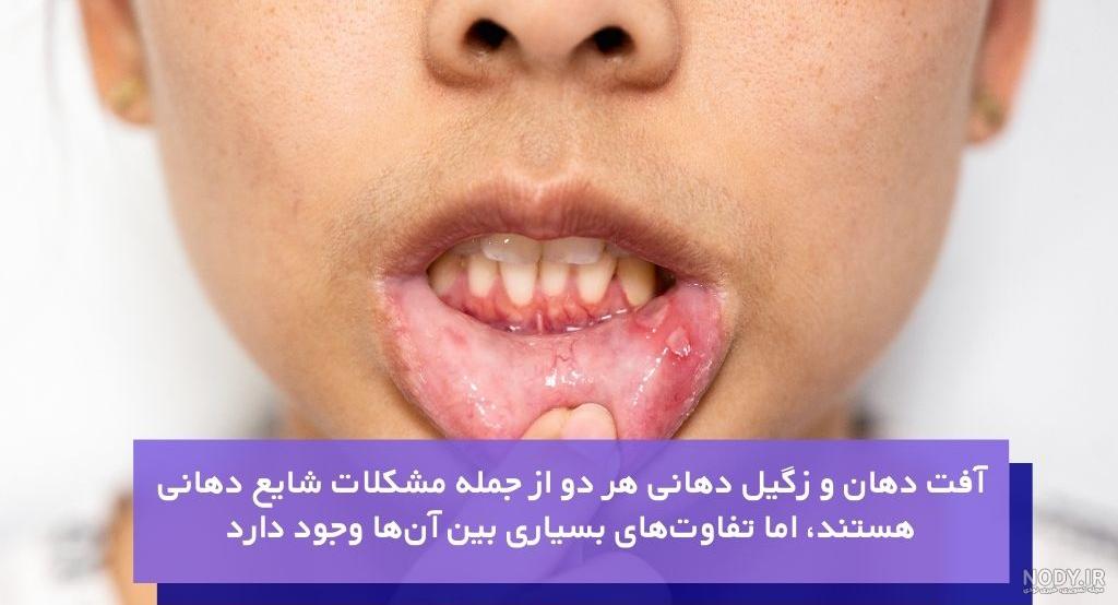 زگیل دهانی یا HPV دهانی چیست و چگونه تشخیص داده میشود؟ زگیل دهانی یا HPV دهانی چیست و چگونه تشخیص داده میشود؟