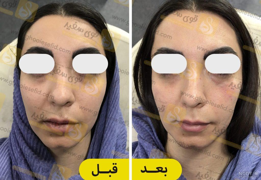 طراحی و کانتورینگ چهره با تزریق فیلر صورت + عکس قبل و بعد - کلینیک ماه تهران طراحی و کانتورینگ چهره با تزریق فیلر صورت + عکس قبل و بعد - کلینیک ماه تهران