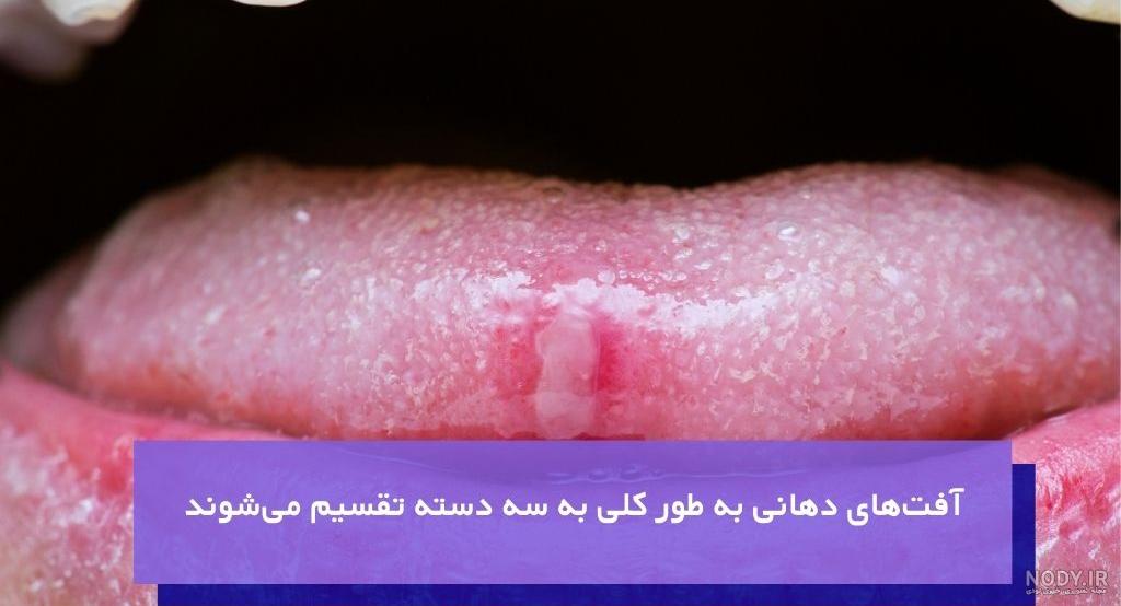 ظاهر شدن نشانه های اچ پی وی و زگیل تناسلی در دهان - کلینیک اورولوژی الهام ظاهر شدن نشانه های اچ پی وی و زگیل تناسلی در دهان - کلینیک اورولوژی الهام