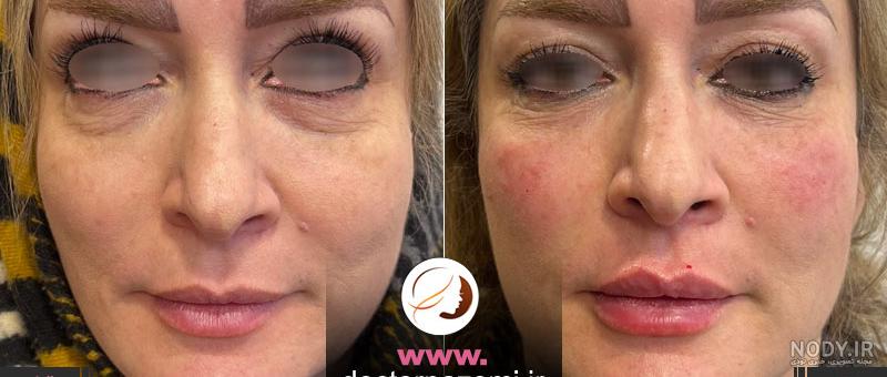 عکس قبل و بعد تزریق فیلر زیر چشم عکس قبل و بعد تزریق فیلر زیر چشم