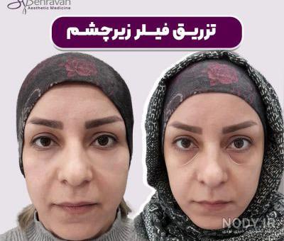 عکس قبل و بعد تزریق چربی زیر چشم بیوتی کلینیک تهران عکس قبل و بعد تزریق چربی زیر چشم بیوتی کلینیک تهران