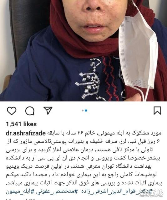 عکس ویروس آبله مرغان عکس ویروس آبله مرغان