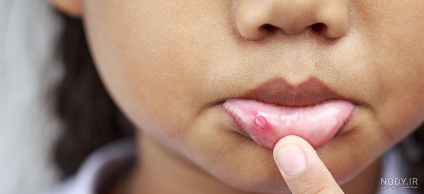 عکس ویروس hpv در دهان عکس ویروس hpv در دهان