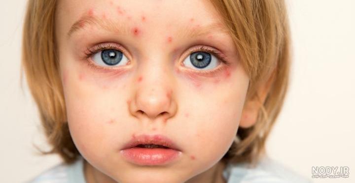 فروشگاه تجهیزات آزمایشگاهی مبنا مد | ویروس واریسلا زوستر (Varicella zoster virus) HHV 3 فروشگاه تجهیزات آزمایشگاهی مبنا مد | ویروس واریسلا زوستر (Varicella zoster virus) HHV 3