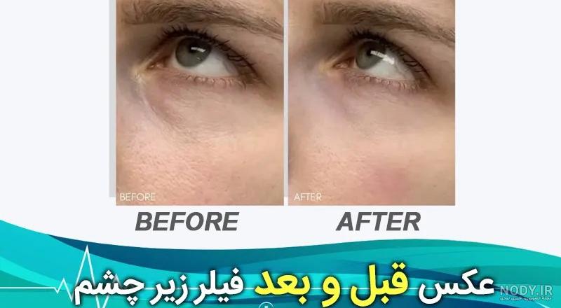 فیلر زیر چشم چیست؟ (قیمت + انواع فیلر زیرچشم) فیلر زیر چشم چیست؟ (قیمت + انواع فیلر زیرچشم)