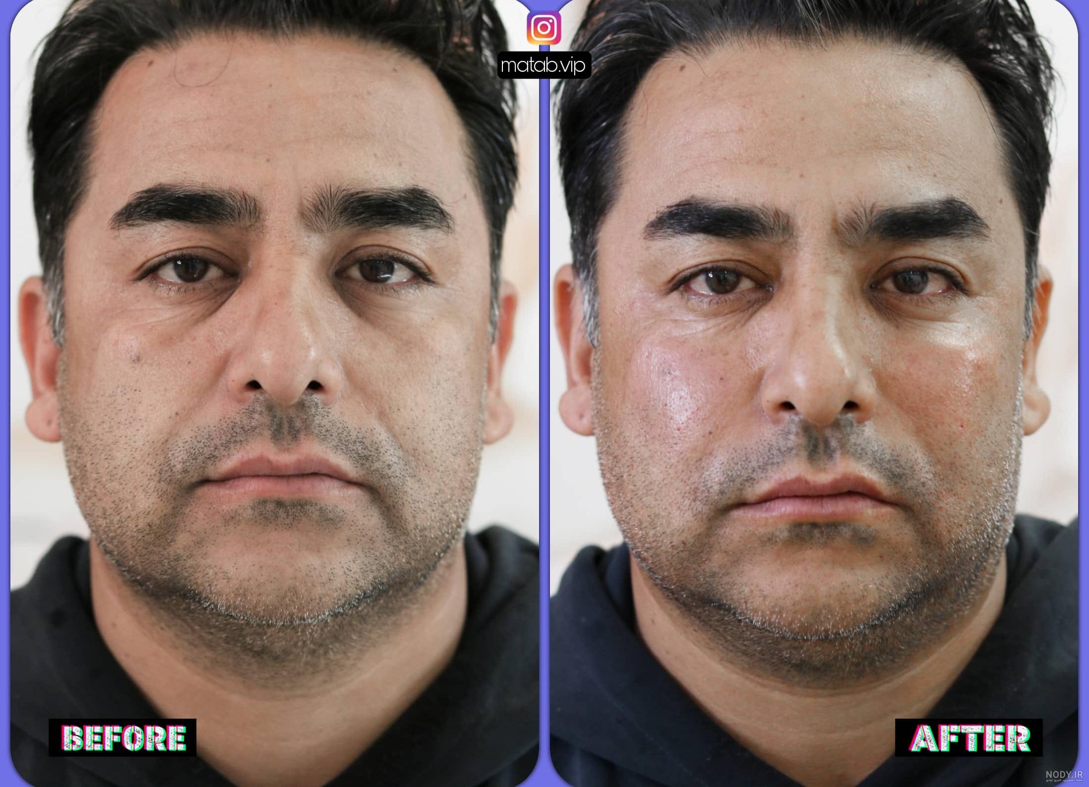 قبل و بعد تزریق ژل زیر چشم خانم ها - دکتر امامی قبل و بعد تزریق ژل زیر چشم خانم ها - دکتر امامی