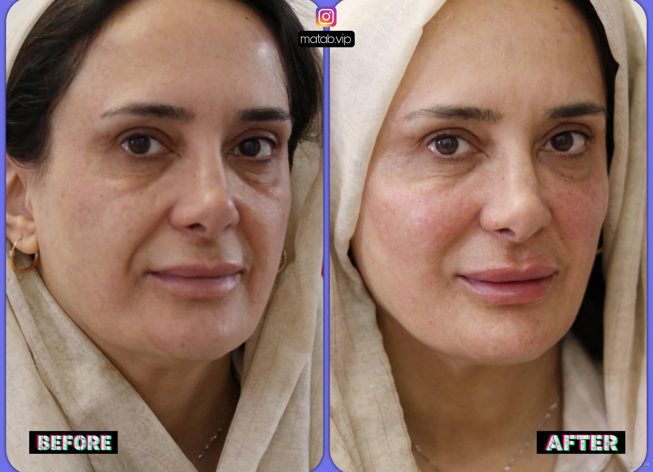 قیمت فیلر زیر چشم ۱۴۰۳ (هزینه مهر) ❤️ + عکس قبل و بعد✔️ قیمت فیلر زیر چشم ۱۴۰۳ (هزینه مهر) ❤️ + عکس قبل و بعد✔️