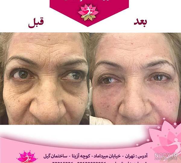 قیمت فیلر زیر چشم ۱۴۰۳ (هزینه مهر) ❤️ + عکس قبل و بعد✔️ قیمت فیلر زیر چشم ۱۴۰۳ (هزینه مهر) ❤️ + عکس قبل و بعد✔️
