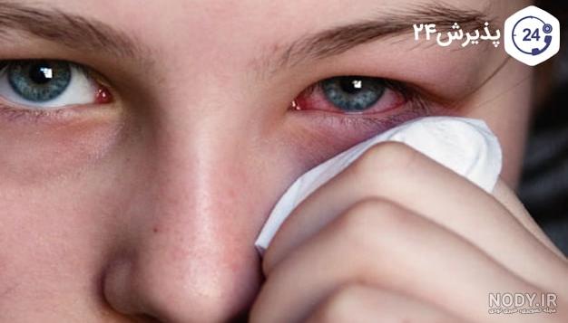 آیا صورتی شدن چشم نشانه عفونت است؟ | دکتر گلدیس اسپندار|چشم پزشک|فوق تخصص قرنیه|فاطمی|گیشا|امیرآباد آیا صورتی شدن چشم نشانه عفونت است؟ | دکتر گلدیس اسپندار|چشم پزشک|فوق تخصص قرنیه|فاطمی|گیشا|امیرآباد