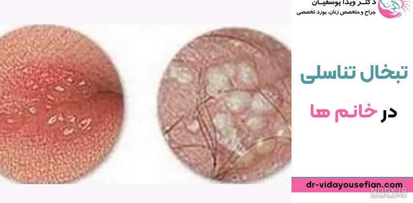 تبخال دهانی و تناسلی ویروسی (Herpes Simplex Virus) | آزمایشگاه وحید
