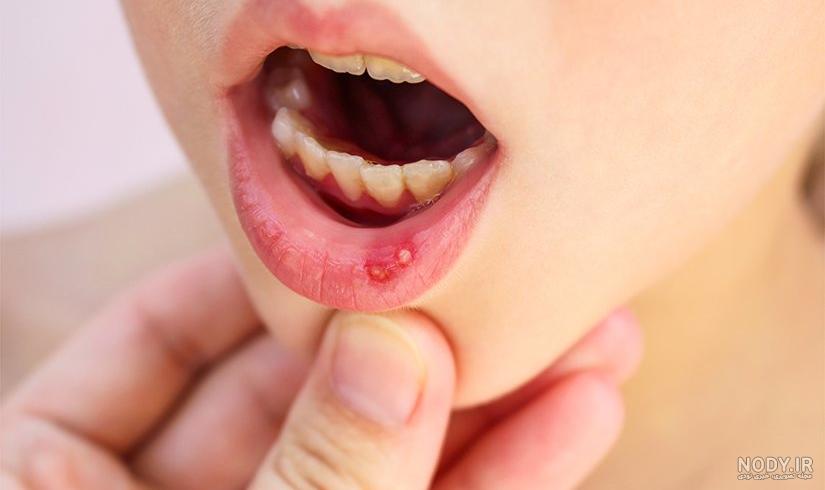 دلایل گلو درد و درمان خانگی آن - سایت پزشکی و مجله سلامتی راستینه
